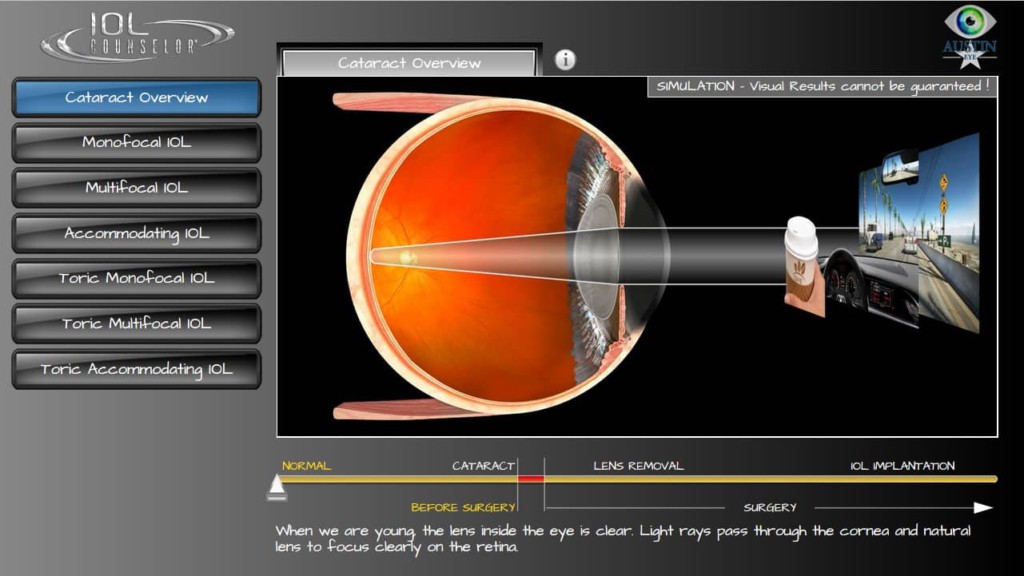 3-D Eye Animations of Eye Problems - Austin Eye