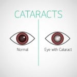 5 things to know about cataracts
