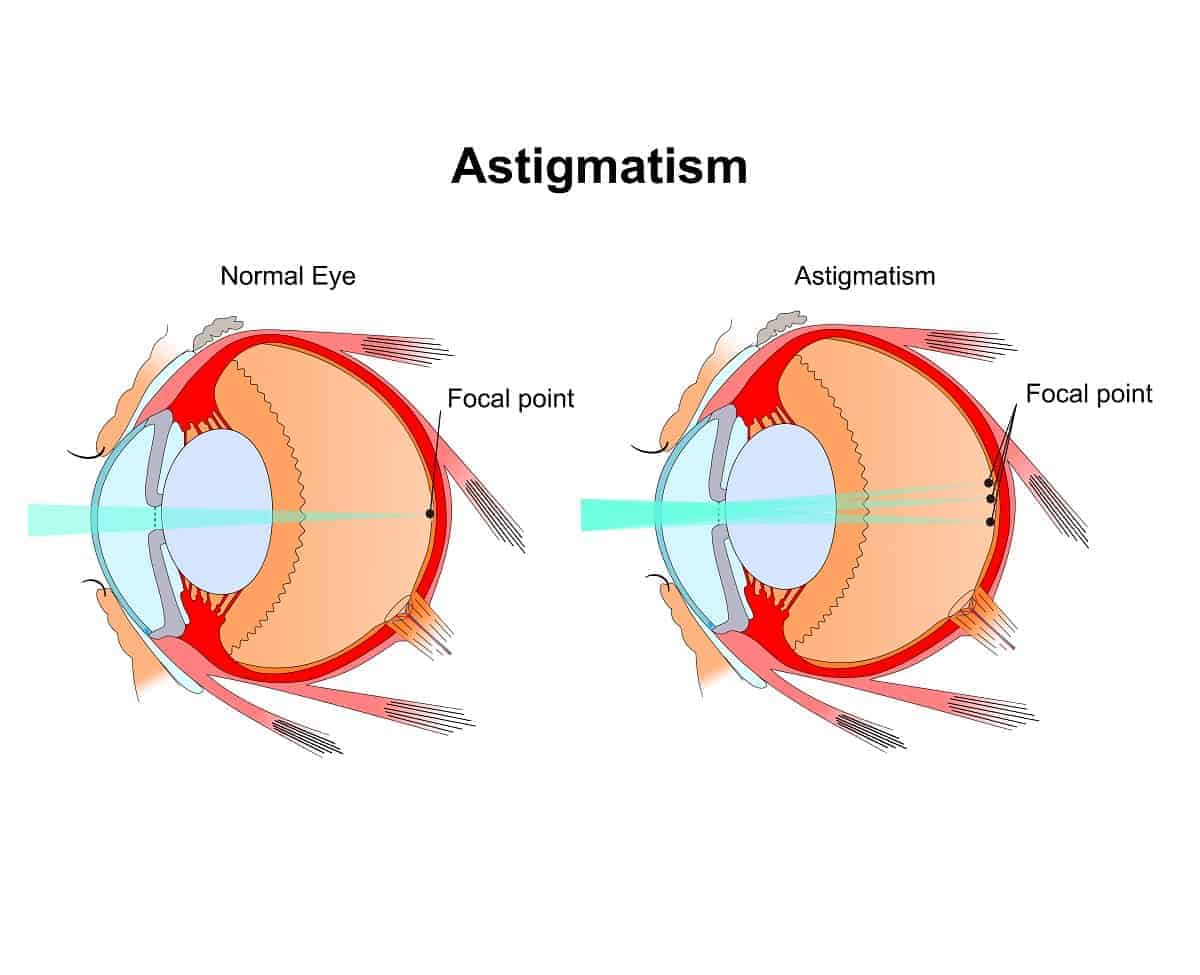 Astigmatism: Causes & Treatment Options in Austin, TX