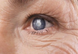 5 Things about Glaucoma 