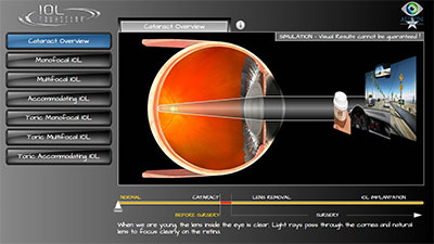 Video simulator - Cataract IOL