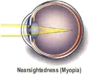 Austin TX nearsightedness correction