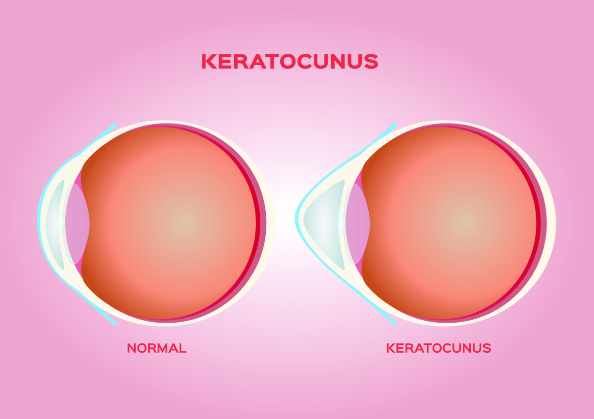 Corneal Crosslinking Can Improve Keratoconus