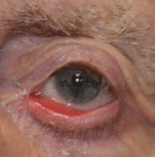 ectropion
