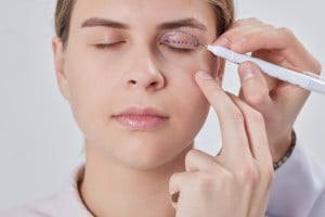 Dermatochalasis
