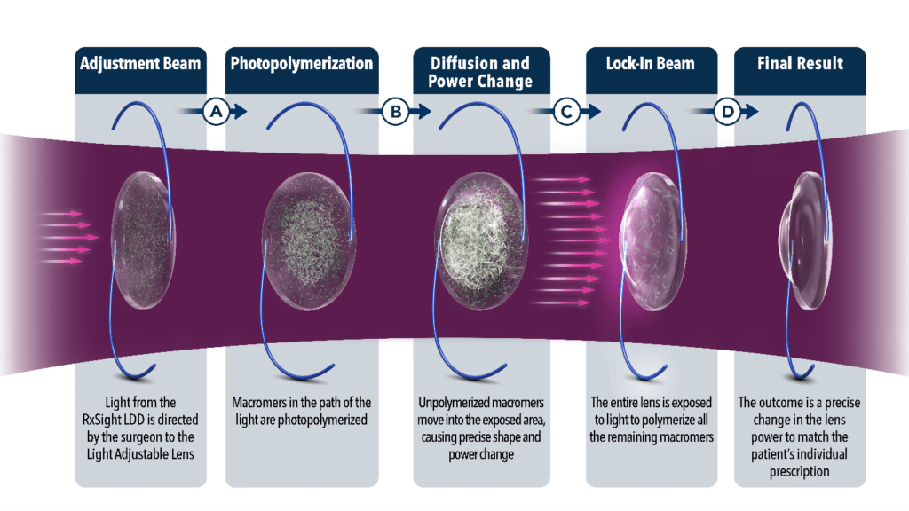 The Light Adjustable Lens (LAL) in Austin