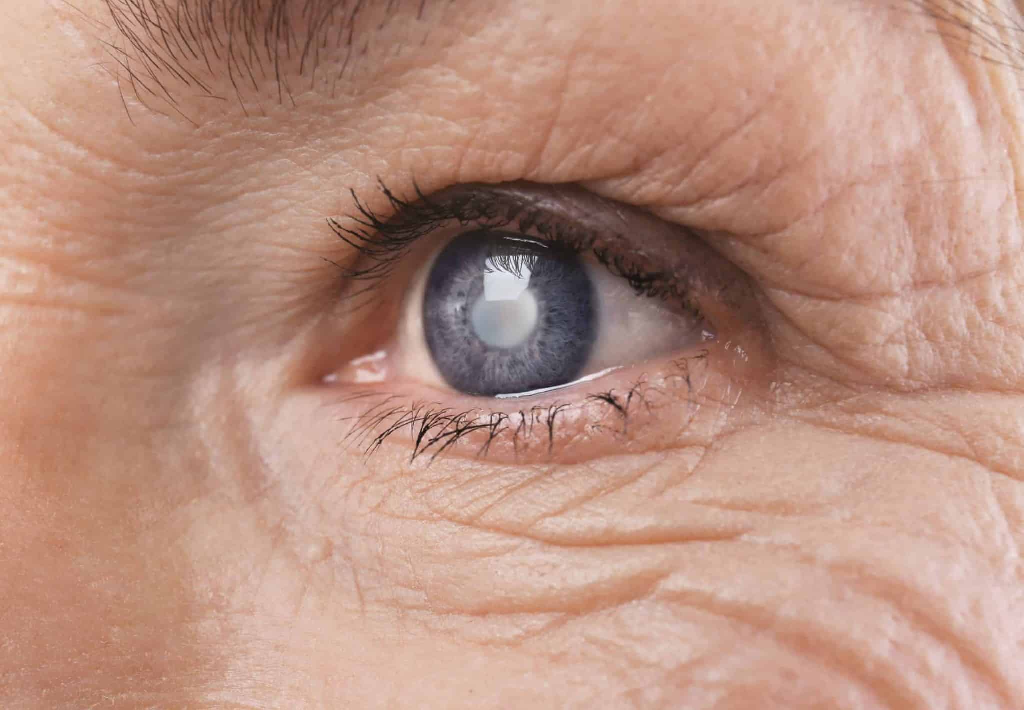 5 Things about Glaucoma