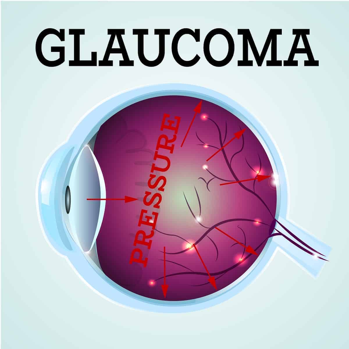 Glaucoma Treatment in Austin, TX