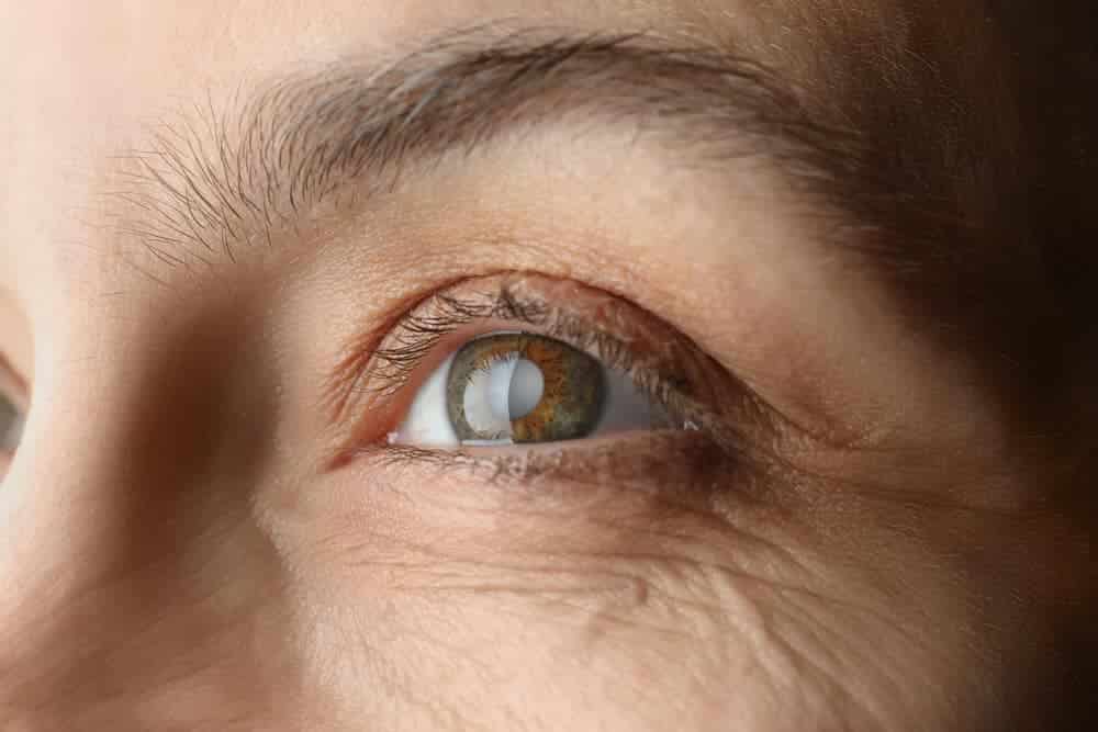 Cataract surgery in Austin, TX