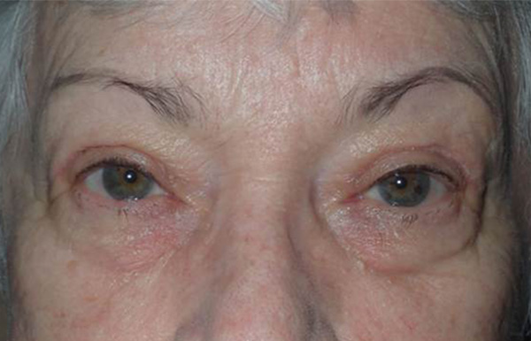 After Image: upper blepharoplasty with external ptosis repair - front