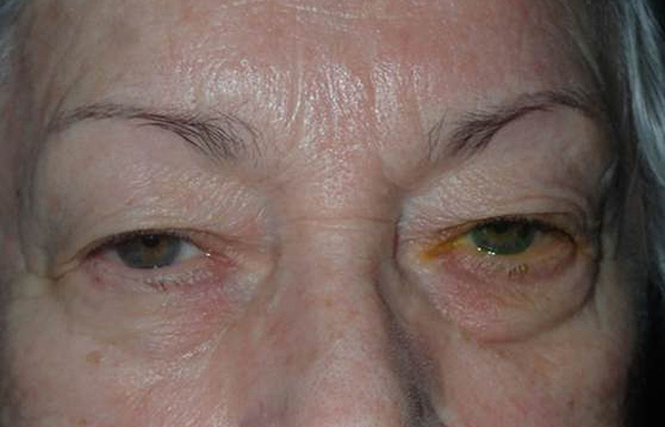 Before Image: upper blepharoplasty with external ptosis repair - front