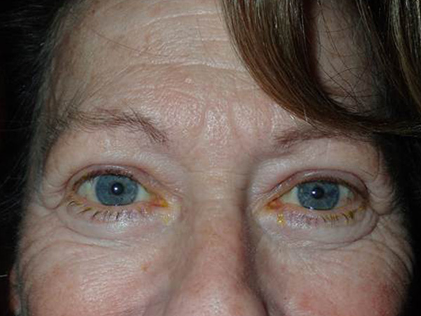 After Image: Direct Brow Lift Incisions / Upper blepharoplasty with internal ptosis repair - front