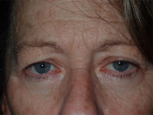 Before Image: Direct Brow Lift Incisions / Upper blepharoplasty with internal ptosis repair - front