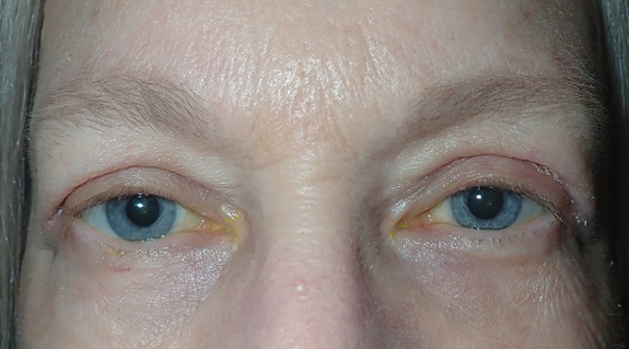 After Image: Upper blepharoplasty: What to expect for swelling first week - front