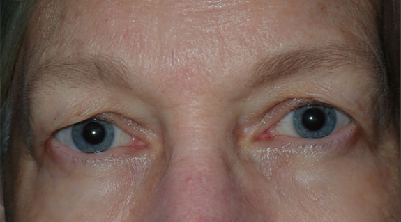 Before Image: Upper blepharoplasty: What to expect for swelling first week - front