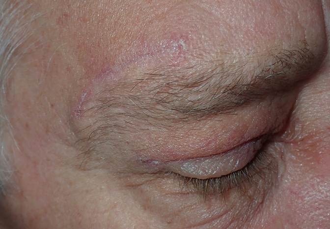 Before and After Image: Upper blepharoplasty and brow lift - right-front-oblique
