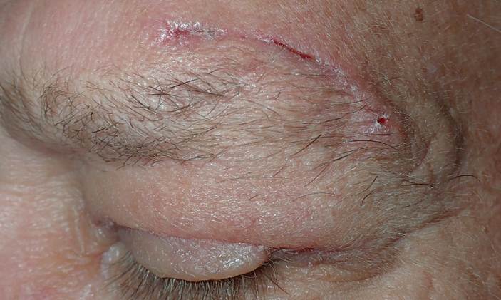Before and After Image: Upper blepharoplasty and brow lift - left-front-oblique