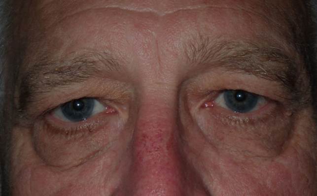 Before and After Image: Upper blepharoplasty and brow lift - front
