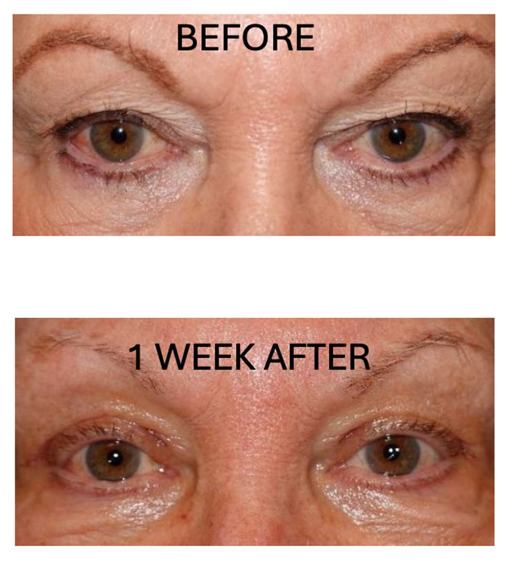 Before and After Image: Blepharoplasty: 1 week - front