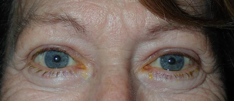 After Image: upper blepharoplasty with external ptosis repair - front