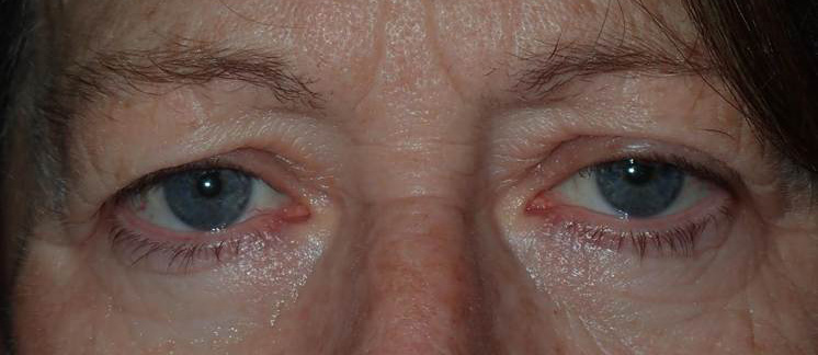 Before Image: upper blepharoplasty with external ptosis repair - front