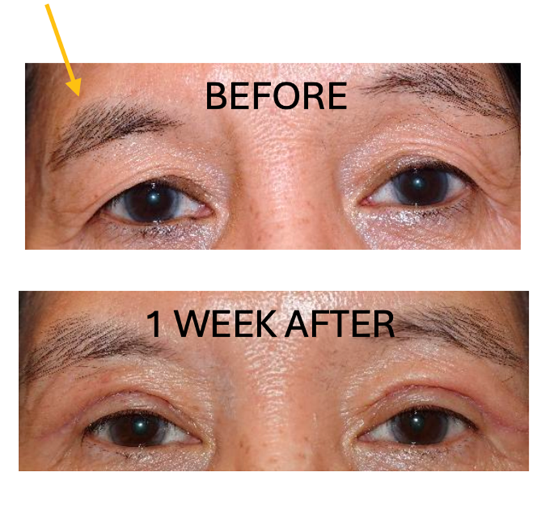 Before and After Image: Blepharoplasty and RIGHT brow elevation: 1 week - front