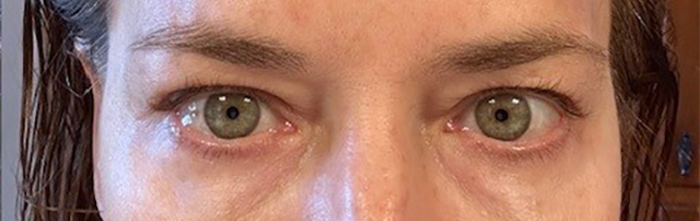Before Image: Brow Support - front