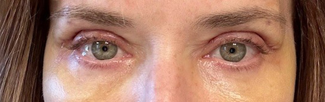 After Image: Brow Support - front
