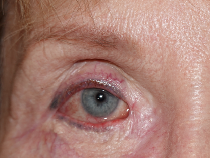 Before and After Image: Complex post traumatic eyelid reconstruction - front