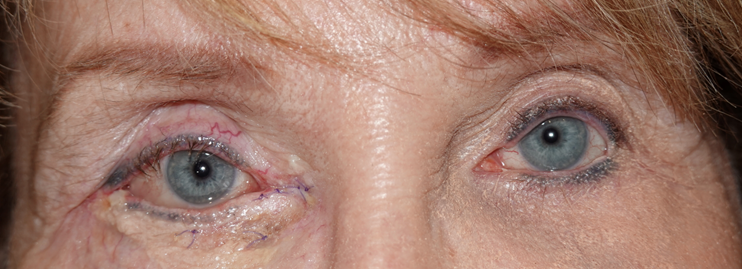 Before and After Image: Complex post traumatic eyelid reconstruction - front