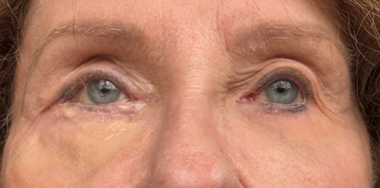 Before and After Image: Complex post traumatic eyelid reconstruction - front
