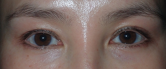 After Image: Internal ptosis repair - front