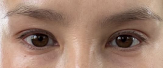 Before Image: Internal ptosis repair - front