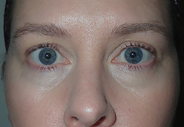 After Image: Upper Blepharoplasty: Bruising to expect first week after surgery - front