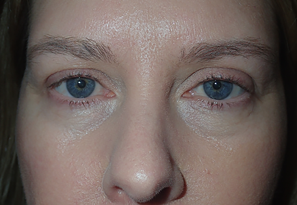 Before Image: Upper Blepharoplasty: Bruising to expect first week after surgery - front