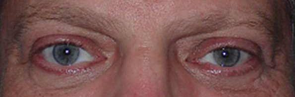 Before and After Image: Upper and Lower lid Blepharoplasty - front