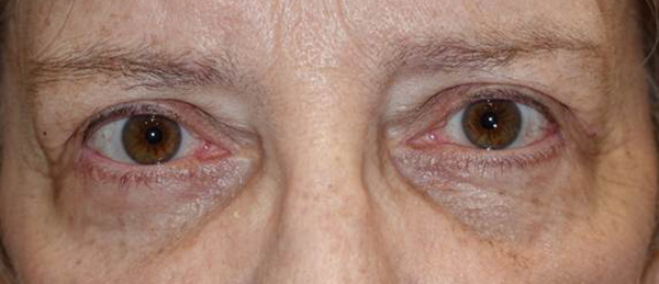 After Image: Upper and lower lid blepharoplasty - front
