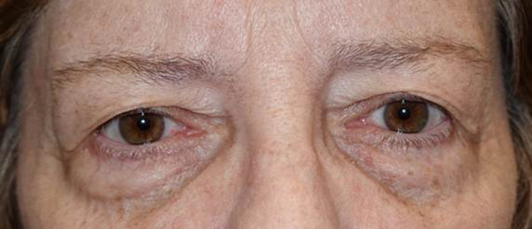 Before Image: Upper and lower lid blepharoplasty - front