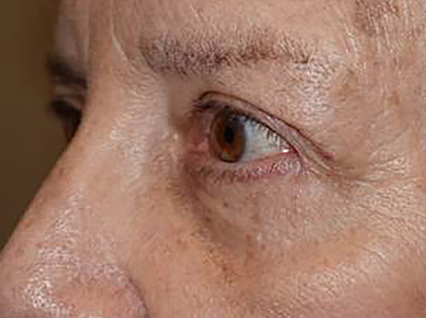 After Image: Upper and lower lid blepharoplasty - left-front-oblique