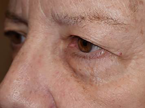 Before Image: Upper and lower lid blepharoplasty - left-front-oblique