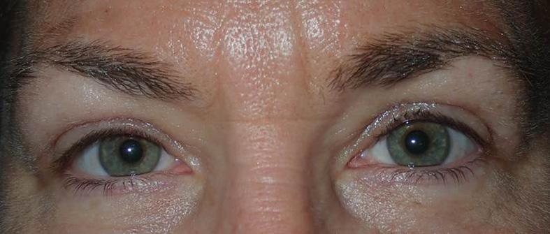 After Image: Upper blepharoplasty and internal ptosis repair - front