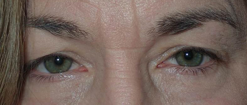 Before Image: Upper blepharoplasty and internal ptosis repair - front