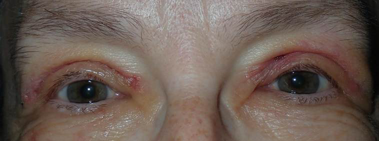 After Image: Upper blepharoplasty: what to expect for bruising the first week - front