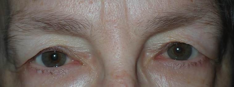 Before Image: Upper blepharoplasty: what to expect for bruising the first week - front